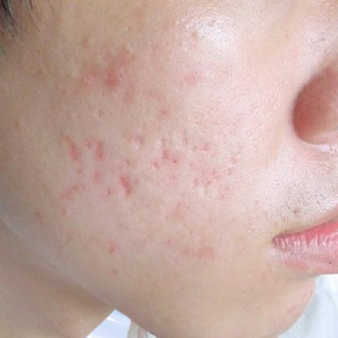 Sẹo lõm, sẹo teo mới