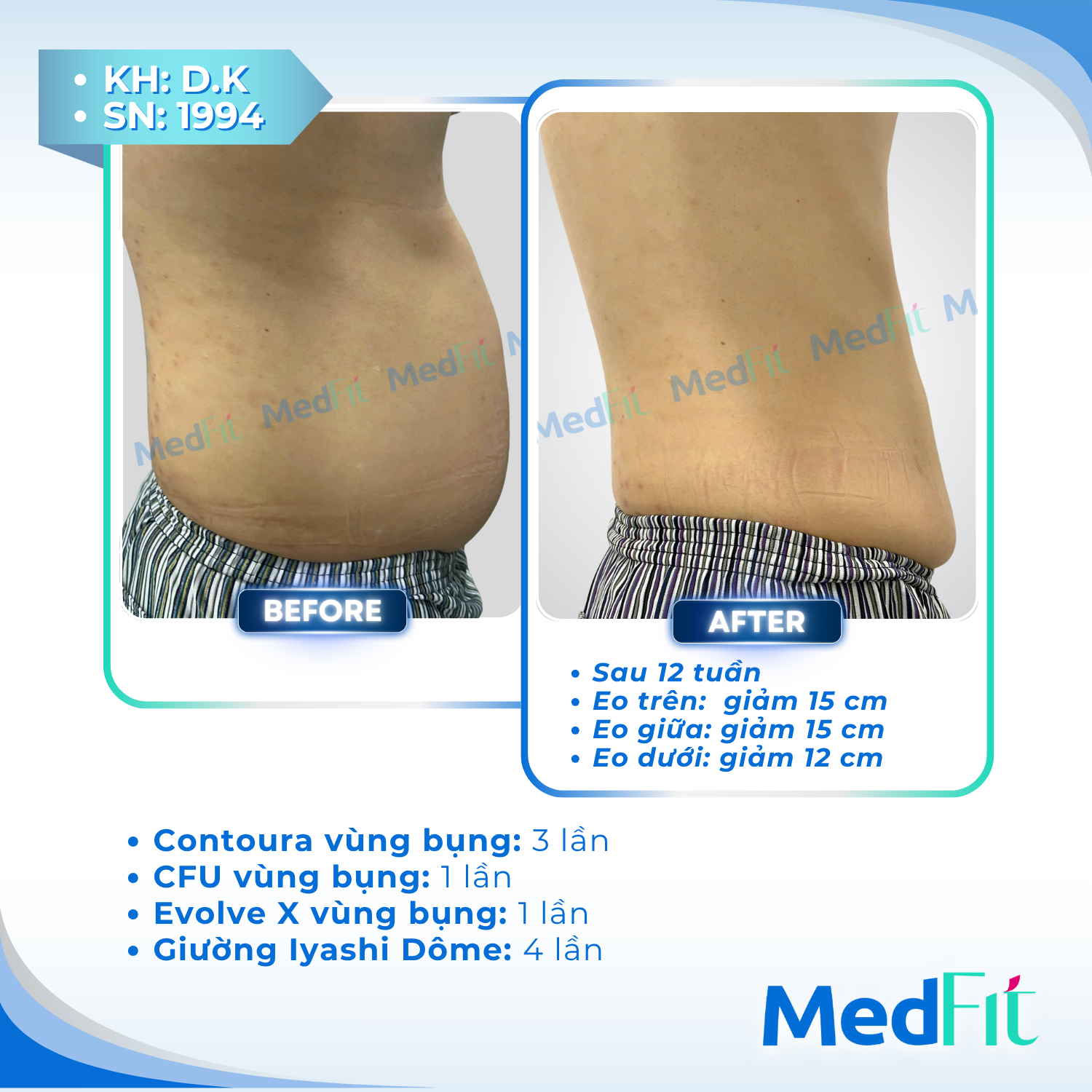 Body contouring 3