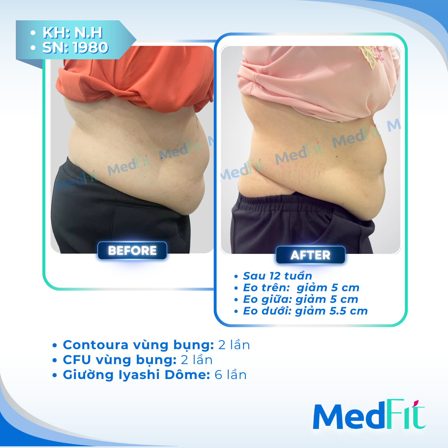 Body contouring 4
