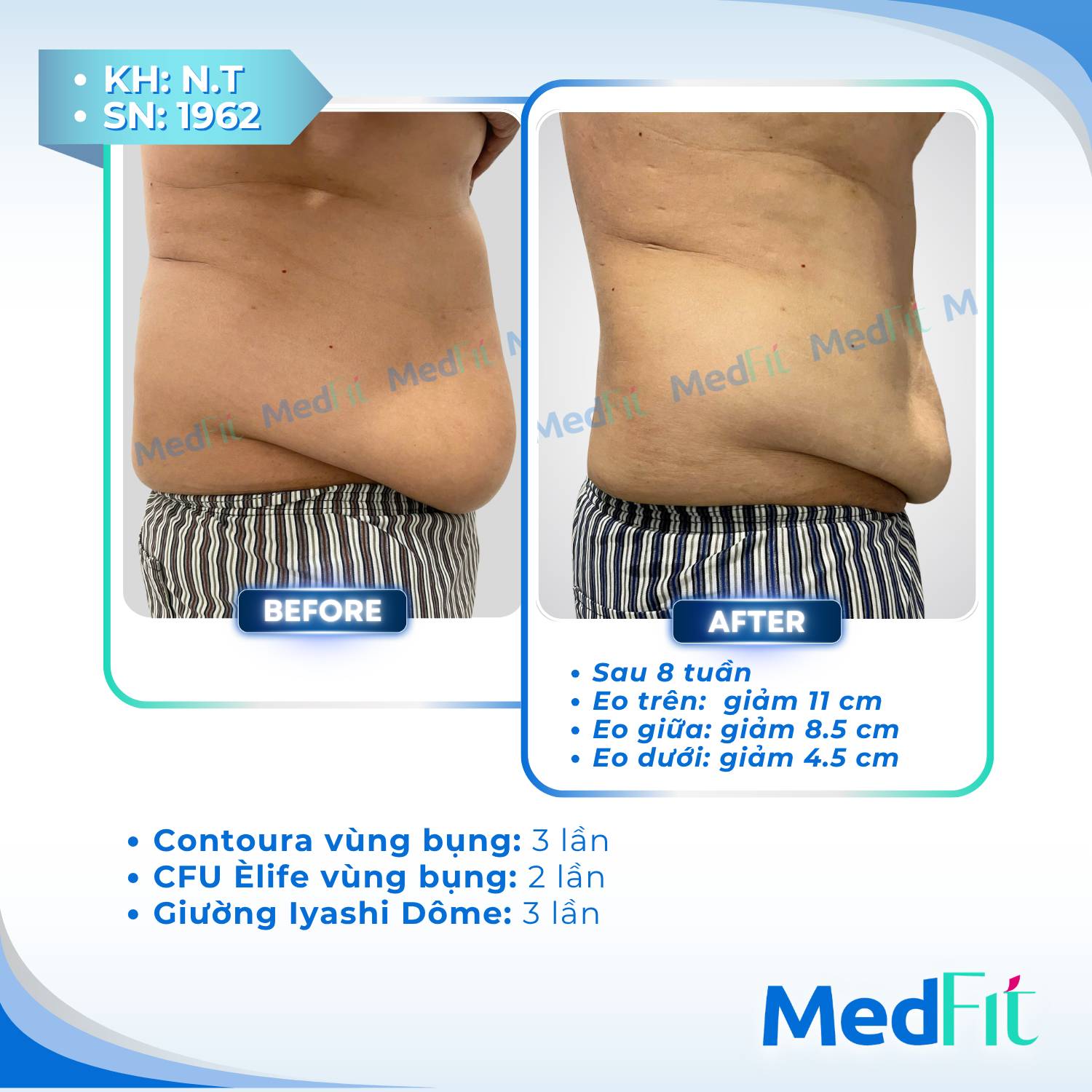 Body contouring 5