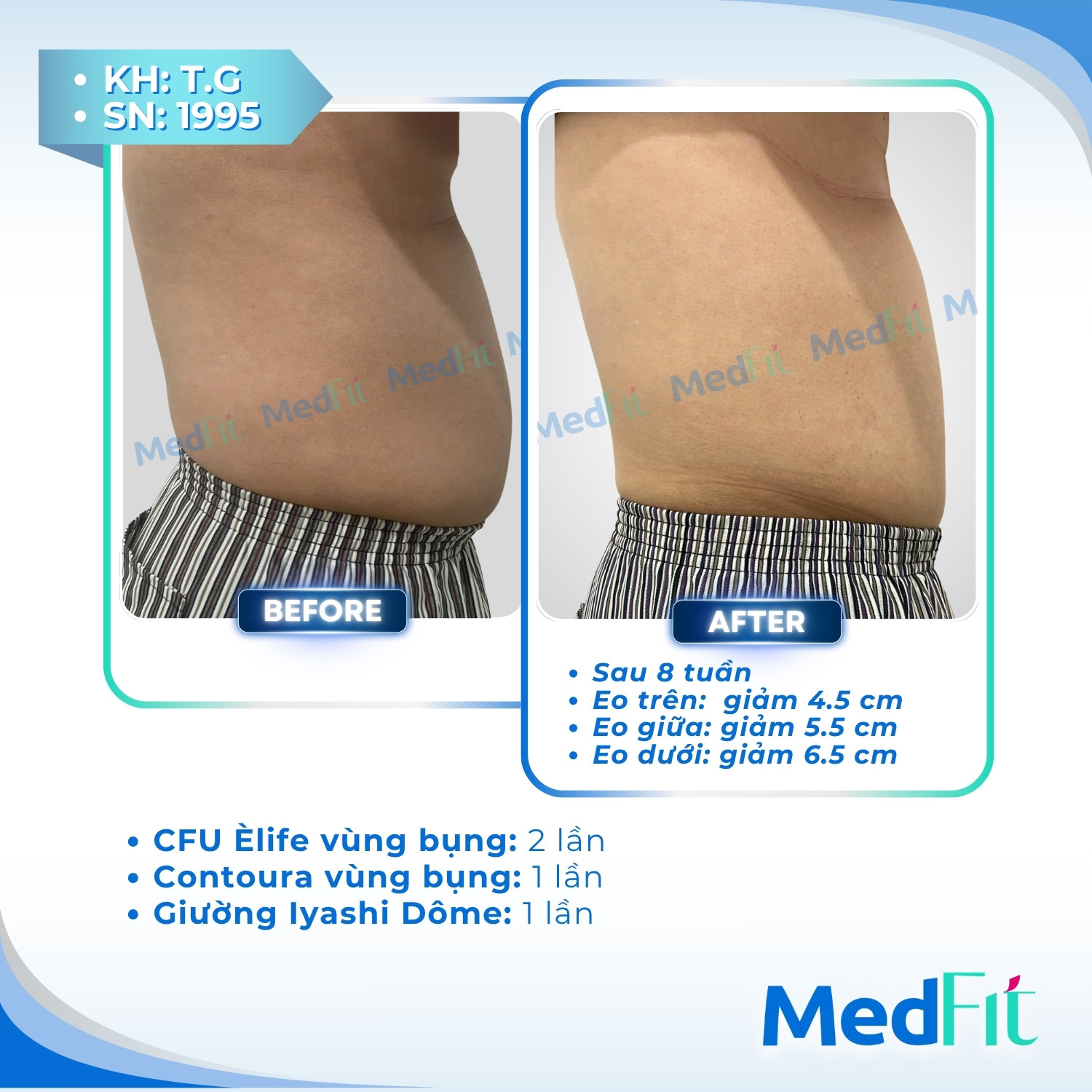 CFU Èlife – Non-invasive facelift, skin tightening & targeted fat loss 4