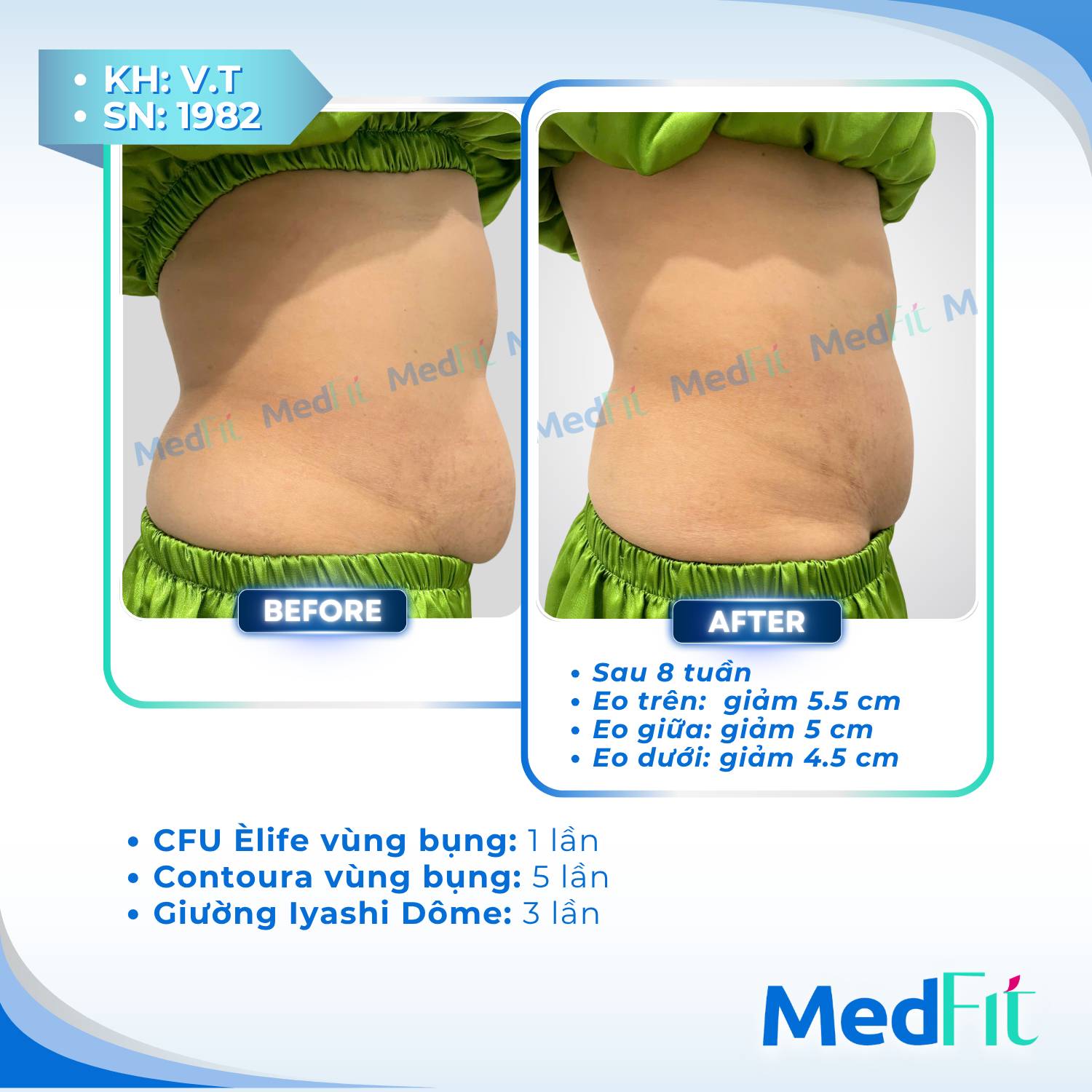 Body contouring 6