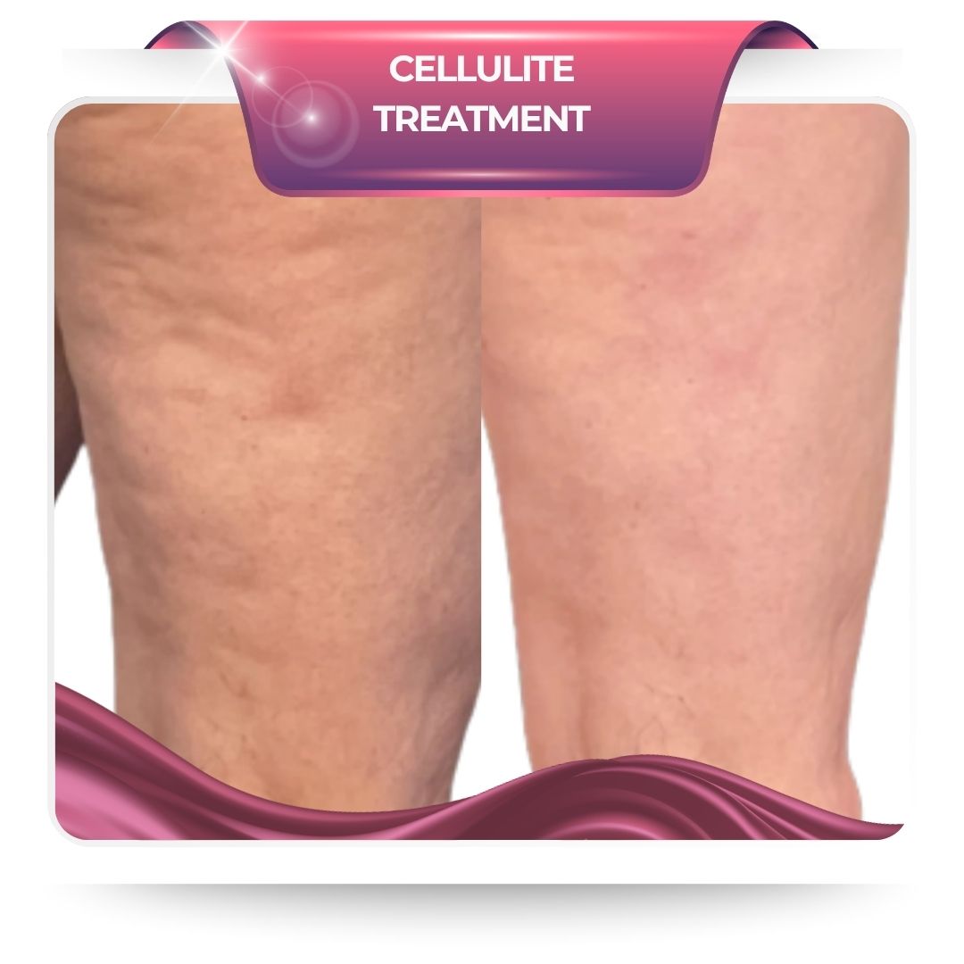 Điều trị cellutide