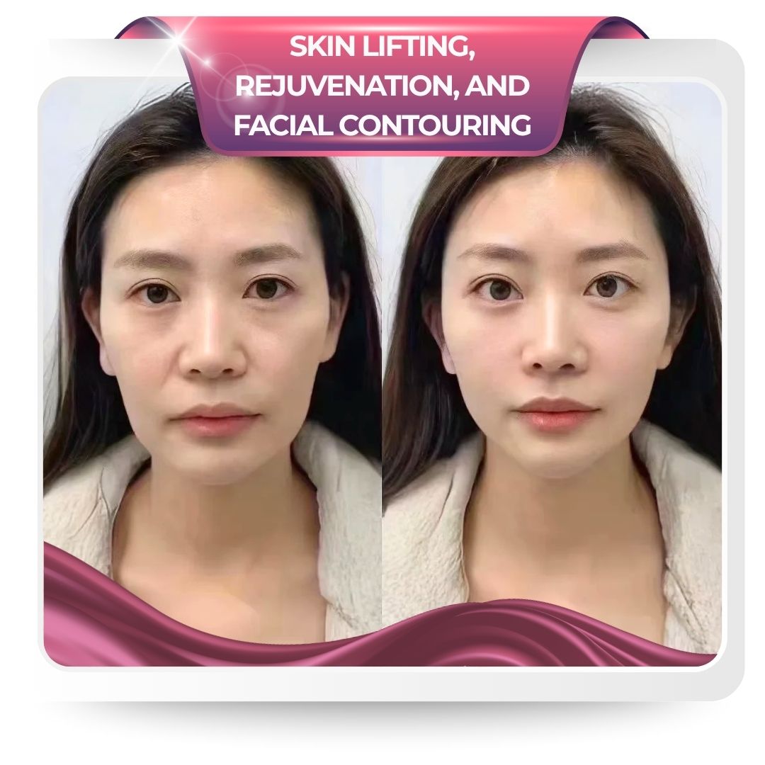 Nâng cơ trẻ hóa da và cân chỉnh khuôn mặt