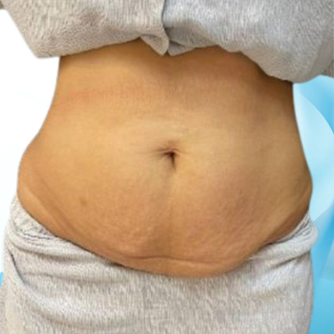 Da lỏng lẻo chảy xệ