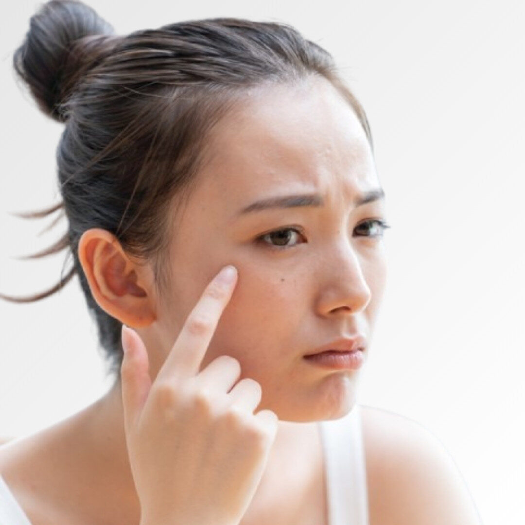 Làn da không đều màu Làn da không đều màu