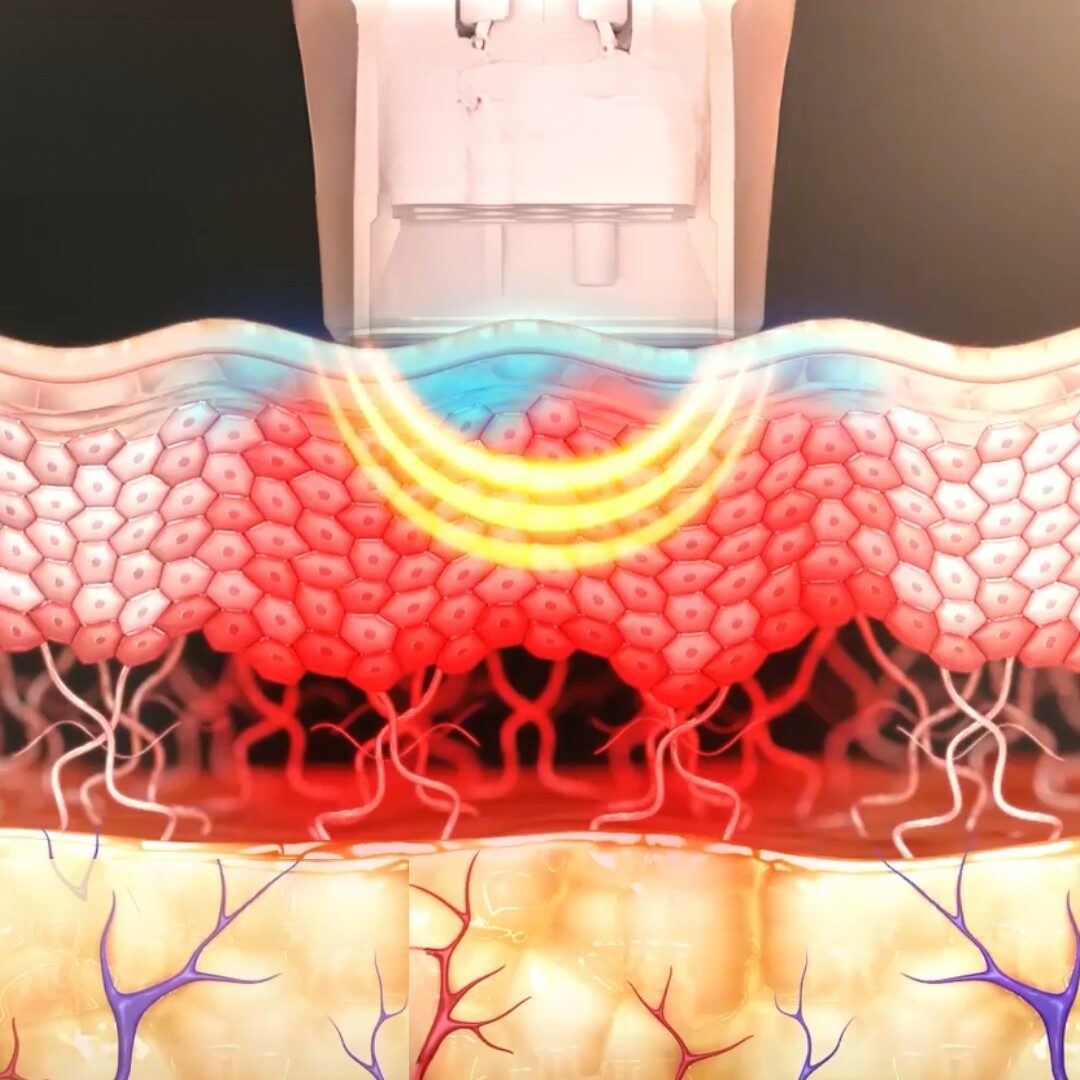 RF lưỡng cực - Bipolar