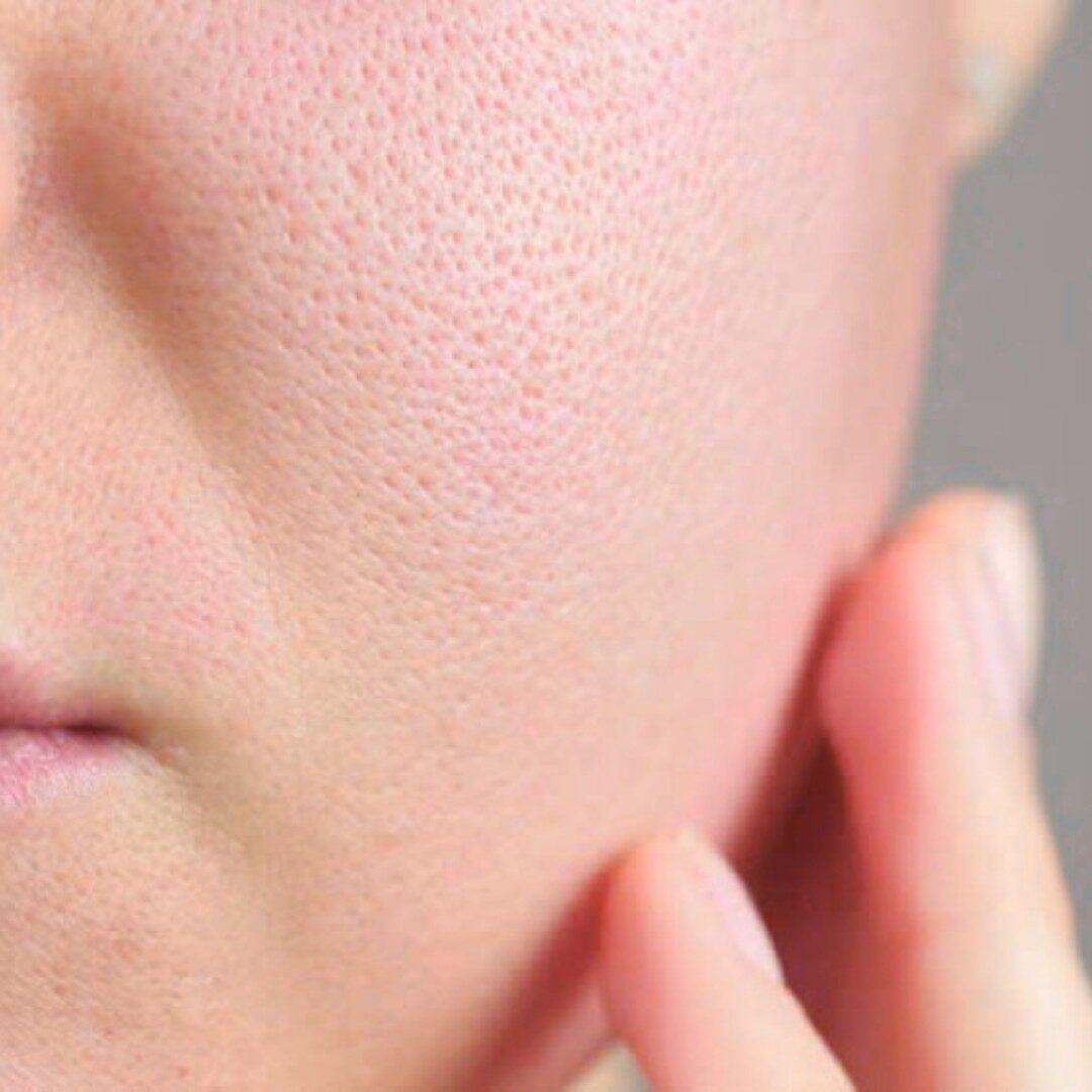 Sẹo đáy nhọn Sẹo đáy nhọn