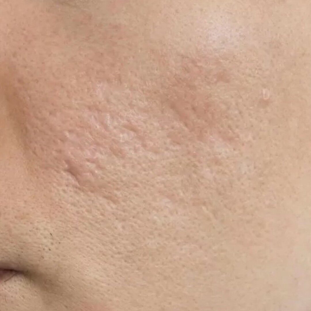 Sẹo hỗn hợp Sẹo hỗn hợp