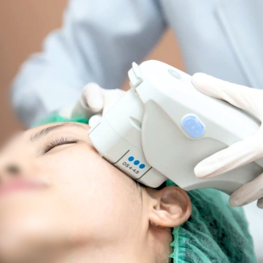 Ultherapy prime vùng mắt
